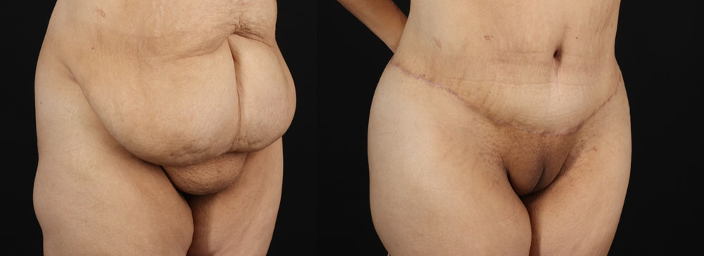 Post Bariatric Surgery (Massive Weight Loss) case #256488