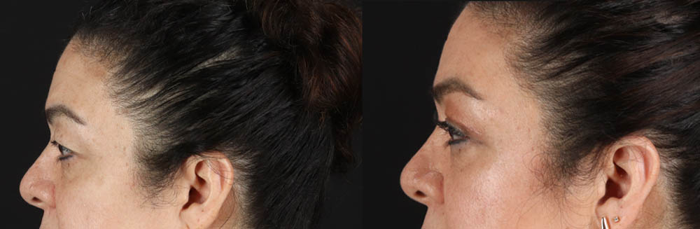 Blepharoplasty case #260106