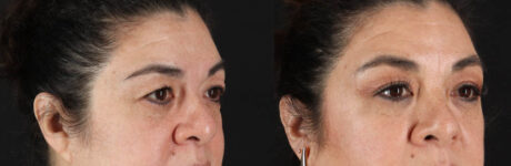 Blepharoplasty case #260106