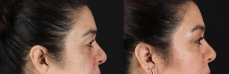 Blepharoplasty case #260106