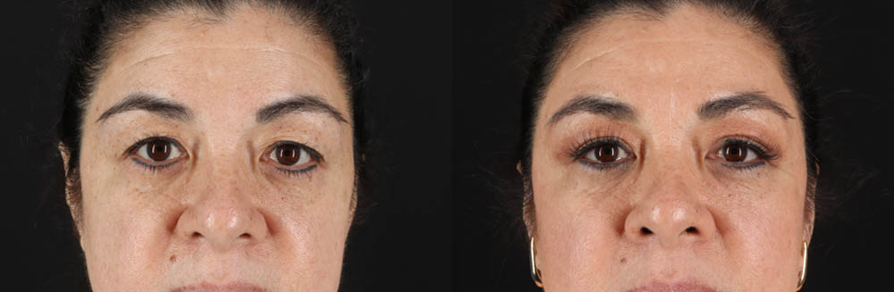 Blepharoplasty case #260106